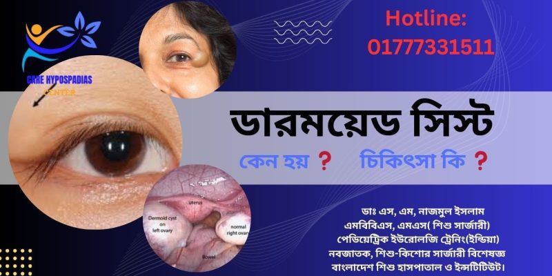 ডারময়েড সিস্ট (Dermoid Cyst)