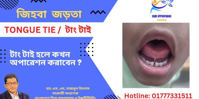 জিহ্বা বন্ধন (Tongue-tie)