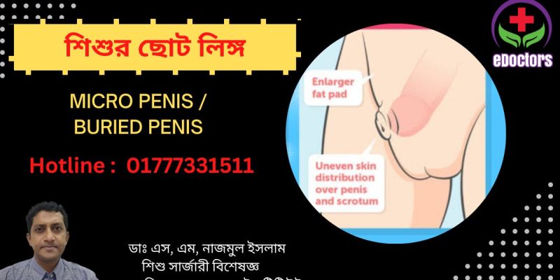 শিশুর ছোট লিঙ্গ Buried Penis