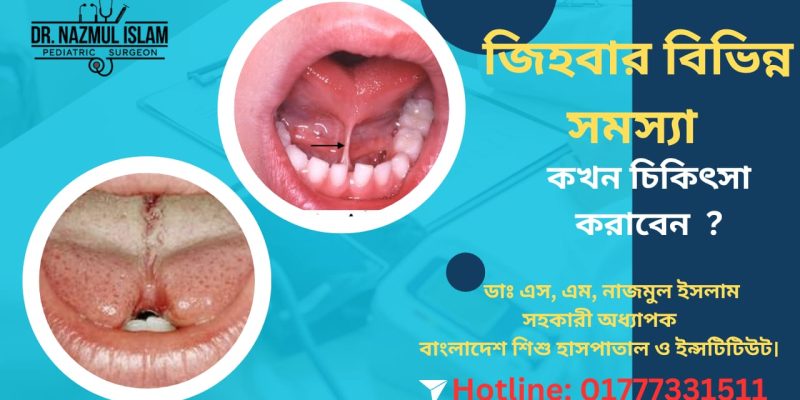 শিশুর জিহবার জন্মগত সমস্যা